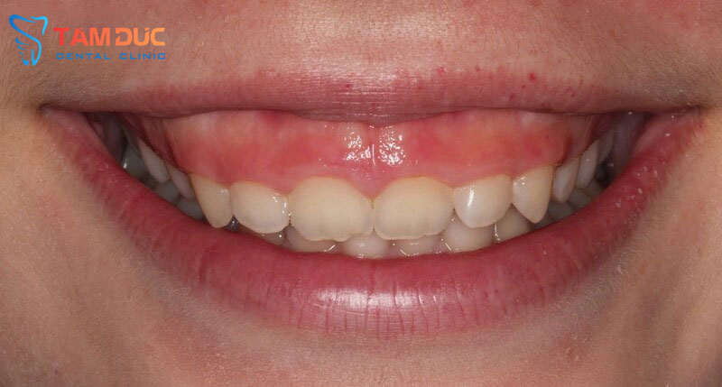 Cười hở lợi ảnh hưởng rất lớn đến thẩm mỹ