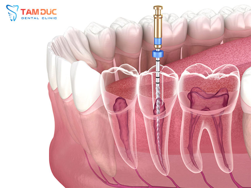 Điều trị tủy răng an toàn, bảo tồn răng thật