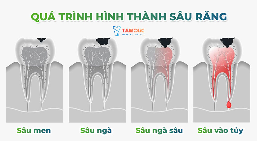 Quá trình hình thành sâu răng