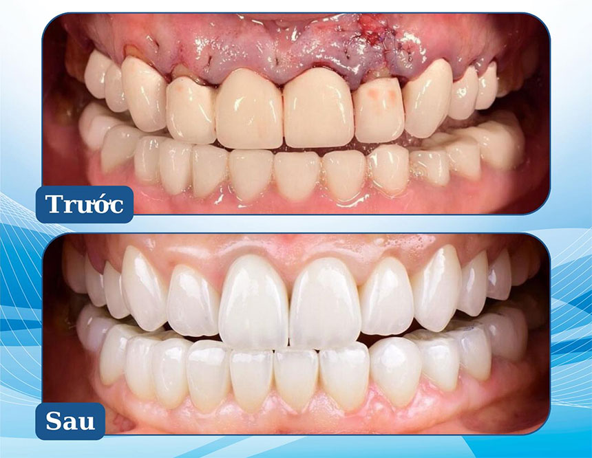 Phẫu thuật tái tạo khoảng sinh học và thay răng sứ mới