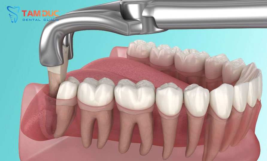 Nhổ răng khôn an toàn hiệu quả tại TP Vinh, Nghệ An