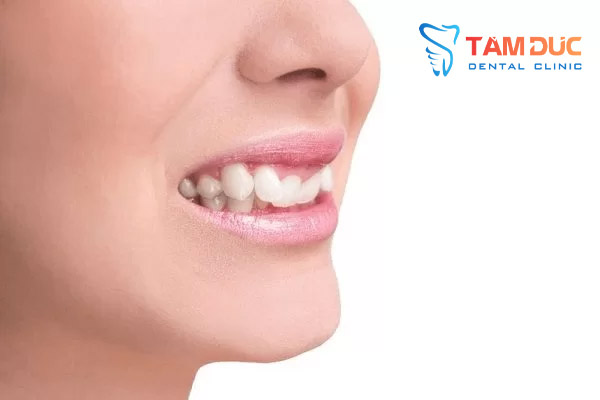 Răng khểnh ko đẹp