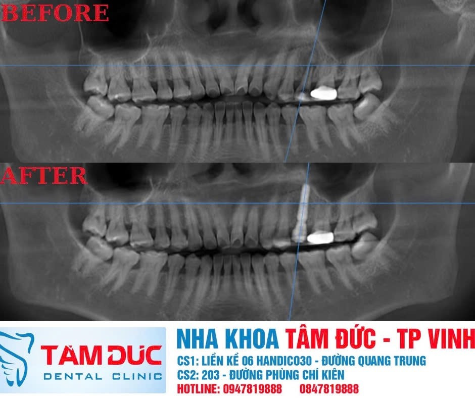 Niềng răng kết hợp cấy ghép Implant tại Nha khoa Tâm Đức Nghệ An