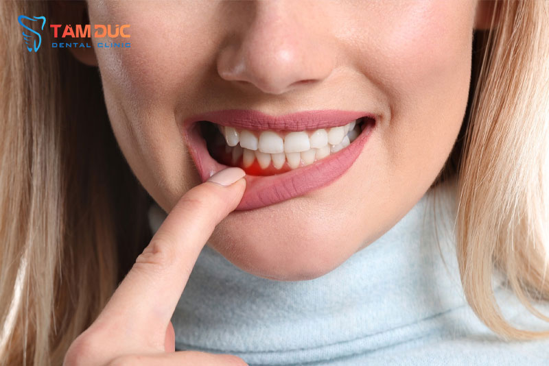 Bệnh nha chu gây viêm nhiễm mô xung quanh răng