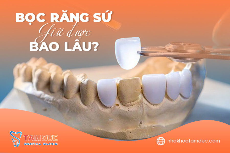 Bọc răng sứ được bao lâu