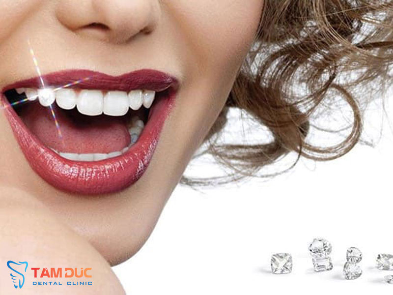 Đính đá kim cương vài răng uy tín tại TP Vinh