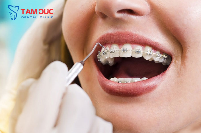 niềng răng Nha Khoa Tâm Đức