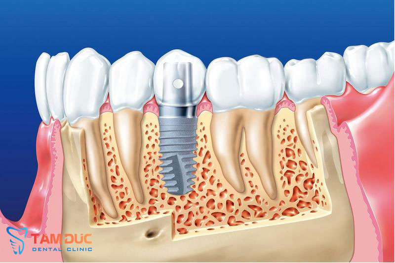 Cấy ghép implant