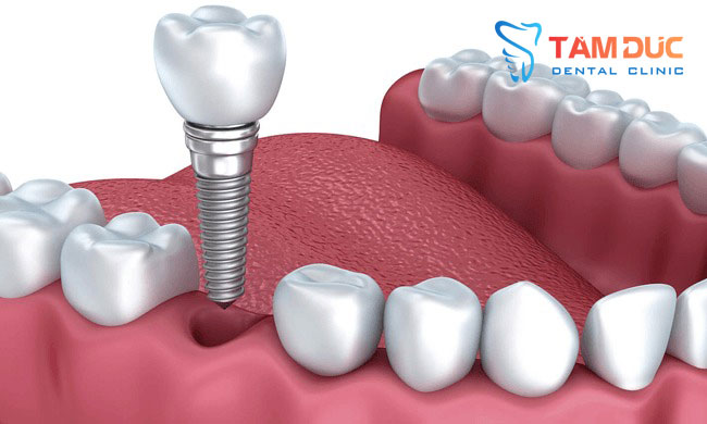 Trồng răng implant chất lượng