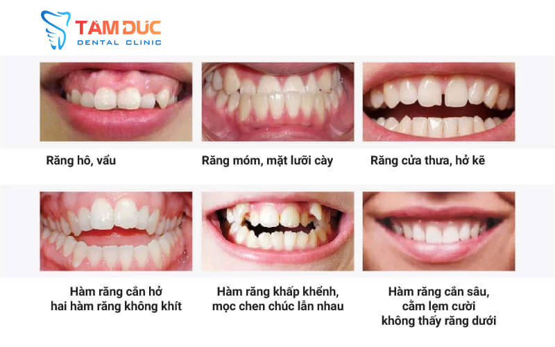 Các trường hợp nên niềng răng để khôi phục tính thẩm mỹ, điều chỉnh khớp cắn&hellip; 