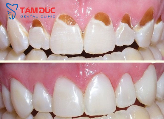 Kết quả hàn trám răng