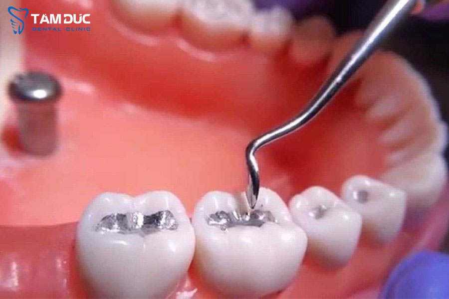 hàn trám răng an toàn tại Nha Khoa Tâm Đức