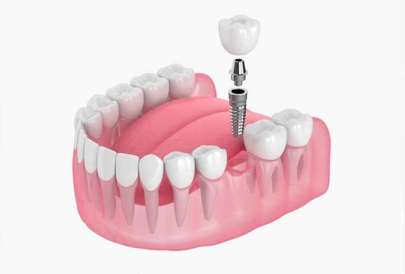 Cấy ghép Implant &ndash; Giải pháp giúp phục hồi răng bị mất hoàn hảo nhất