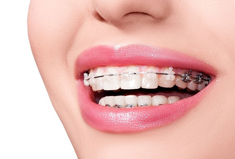 Niềng răng thẩm mỹ – Top 10 địa chỉ niềng răng chất lượng tại TP Vinh