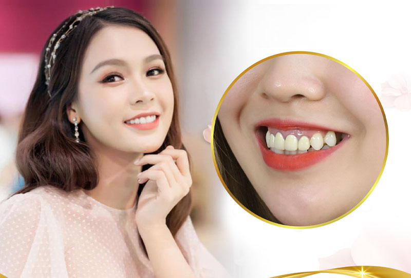 Điều trị cười hở lợi được không và điều trị như thế nào?