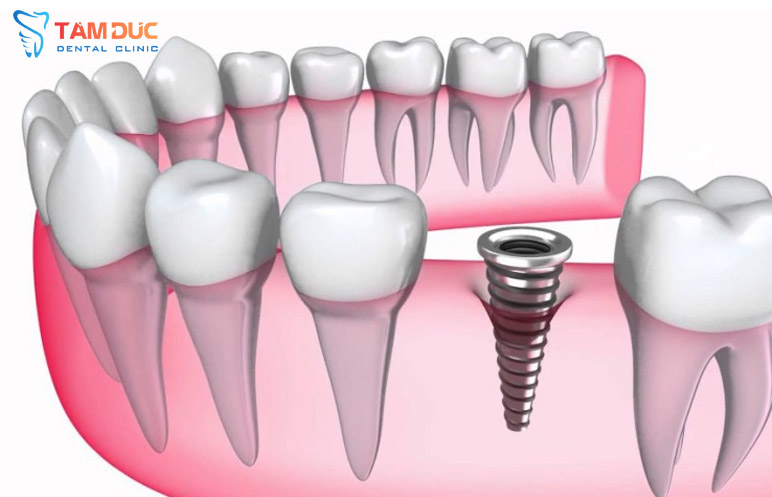 Cấy ghép răng implant chất lượng tại Nghệ An | Nha khoa Tâm Đức
