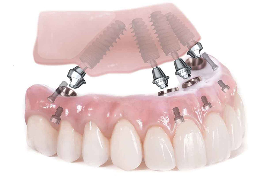 Cấy ghép implant và những câu hỏi thường gặp