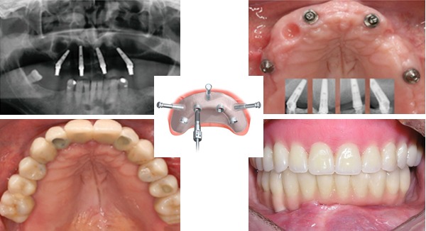implant tại Vinh