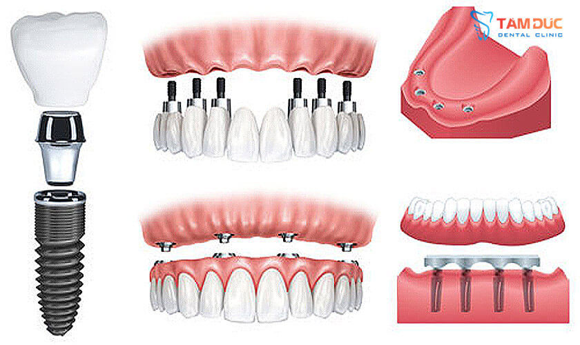 Trồng răng Implant – Giải pháp phục hình răng hoàn hảo